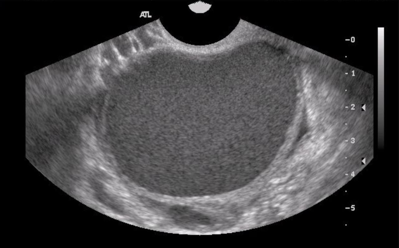 Endometrioma